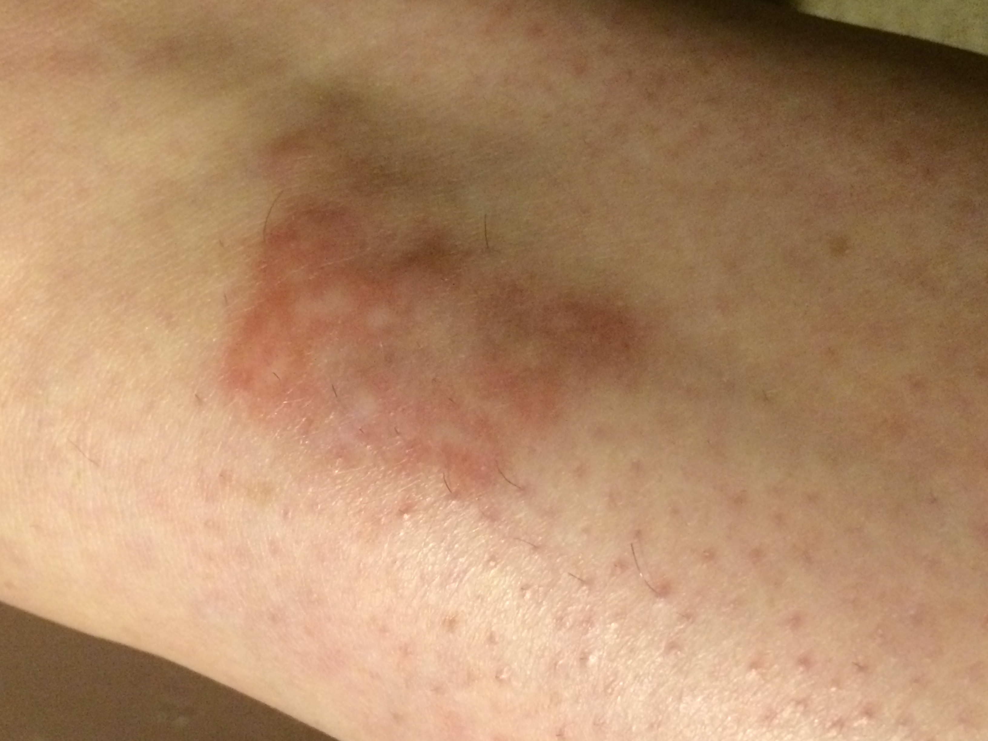 Rote Flecken am Schienbein was ist das? (Hautarzt, Dermatologie)