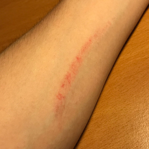 Rote Flecken Am Unterarm Pickel Rote Flecken Am Unterarm Pickel