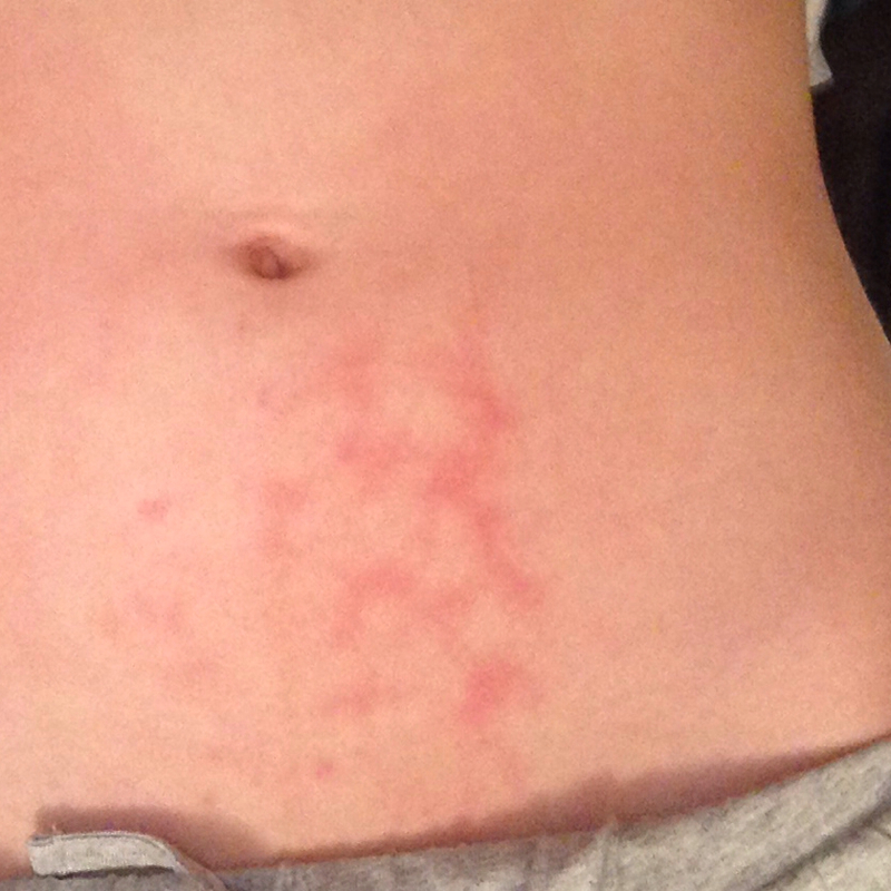 Rote Flecken am Unterbauch (Gesundheit, Haut, krank) Rote Flecken am Unterbauch (Gesundheit, Haut, krank)