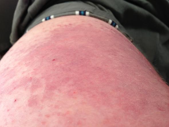 Rote Flecken an den äußeren Oberschenkeln! (Gesundheit, Arzt, Krankheit)