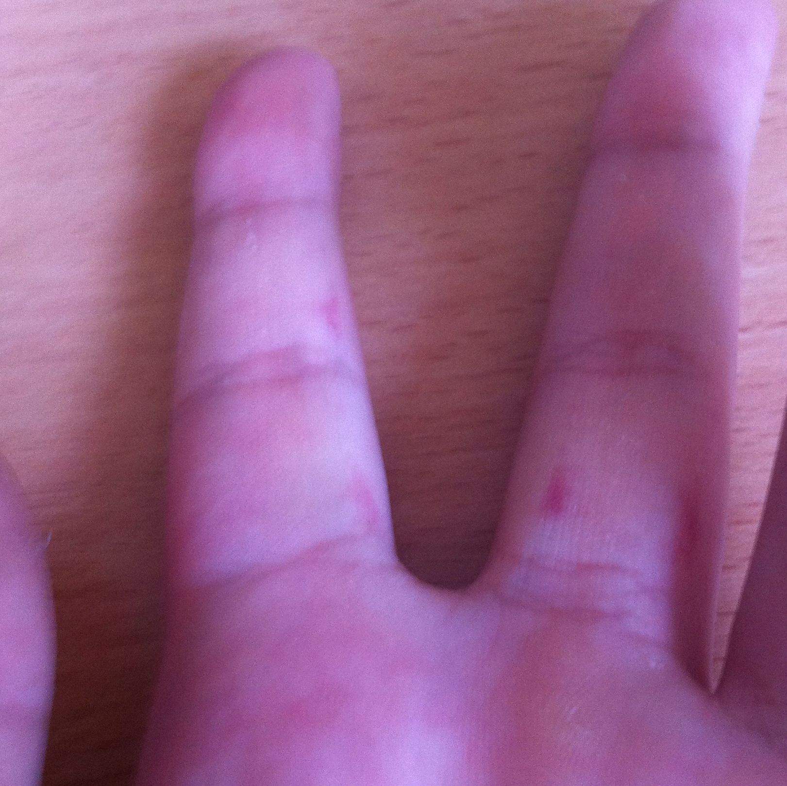 Finger Innen Rillen Rote Flecken an den Fingern aber keine Pickel (Finger)