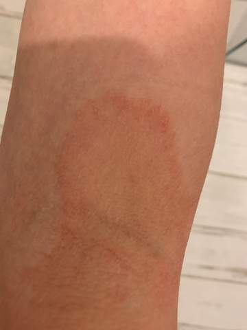 Rote Flecken An Der Haut Gesundheit Und Medizin Rot Rote Flecken An Der Haut Gesundheit Und Medizin Rot