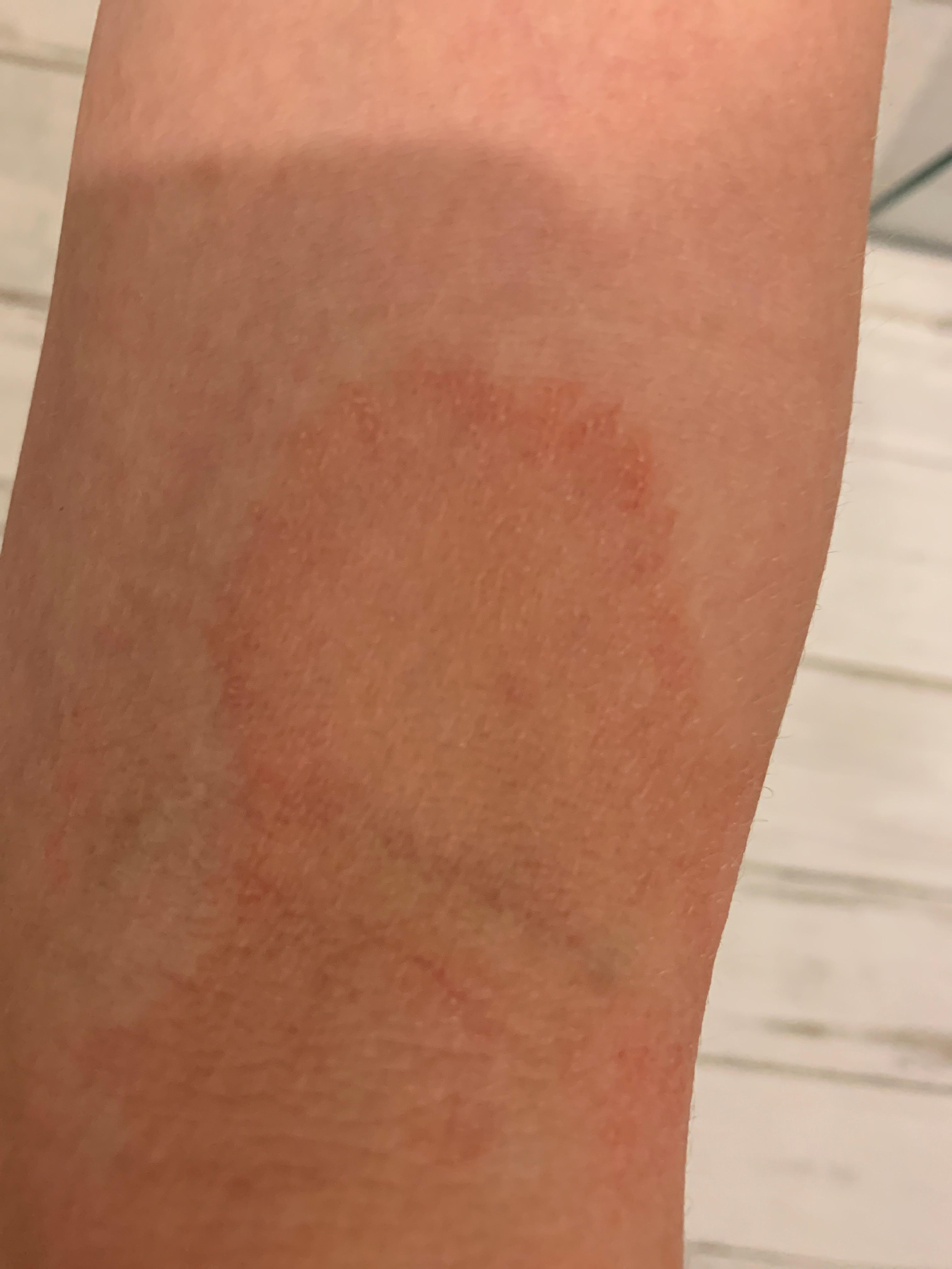 Rote Flecken an der Haut? (Gesundheit und Medizin, rot)