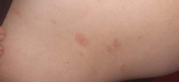 Rote Flecken An Ganzen Korper Haut Sorgen Rote Flecken An Ganzen Korper Haut Sorgen