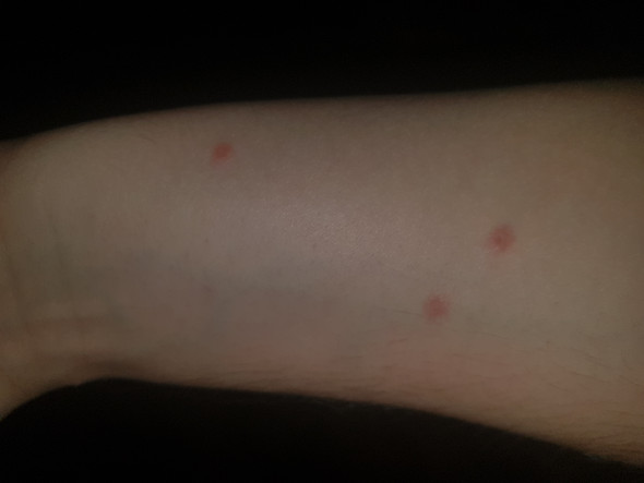 Rote Flecken Auf Dem Arm Und Bauch Haut Rote Flecken Auf Dem Arm Und Bauch Haut