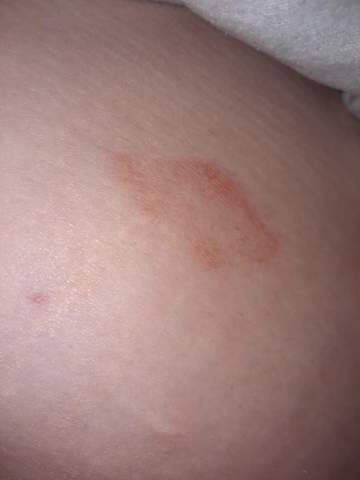 Rote Flecken Auf Der Haut Gesundheit Und Medizin Hautarzt Ausschlag Rote Flecken Auf Der Haut Gesundheit Und Medizin Hautarzt Ausschlag