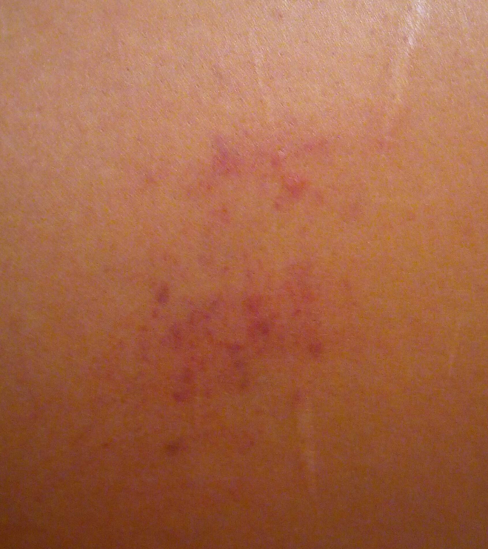 Rote flecken auf der haut kommen und gehen? (Hautkrankheit)