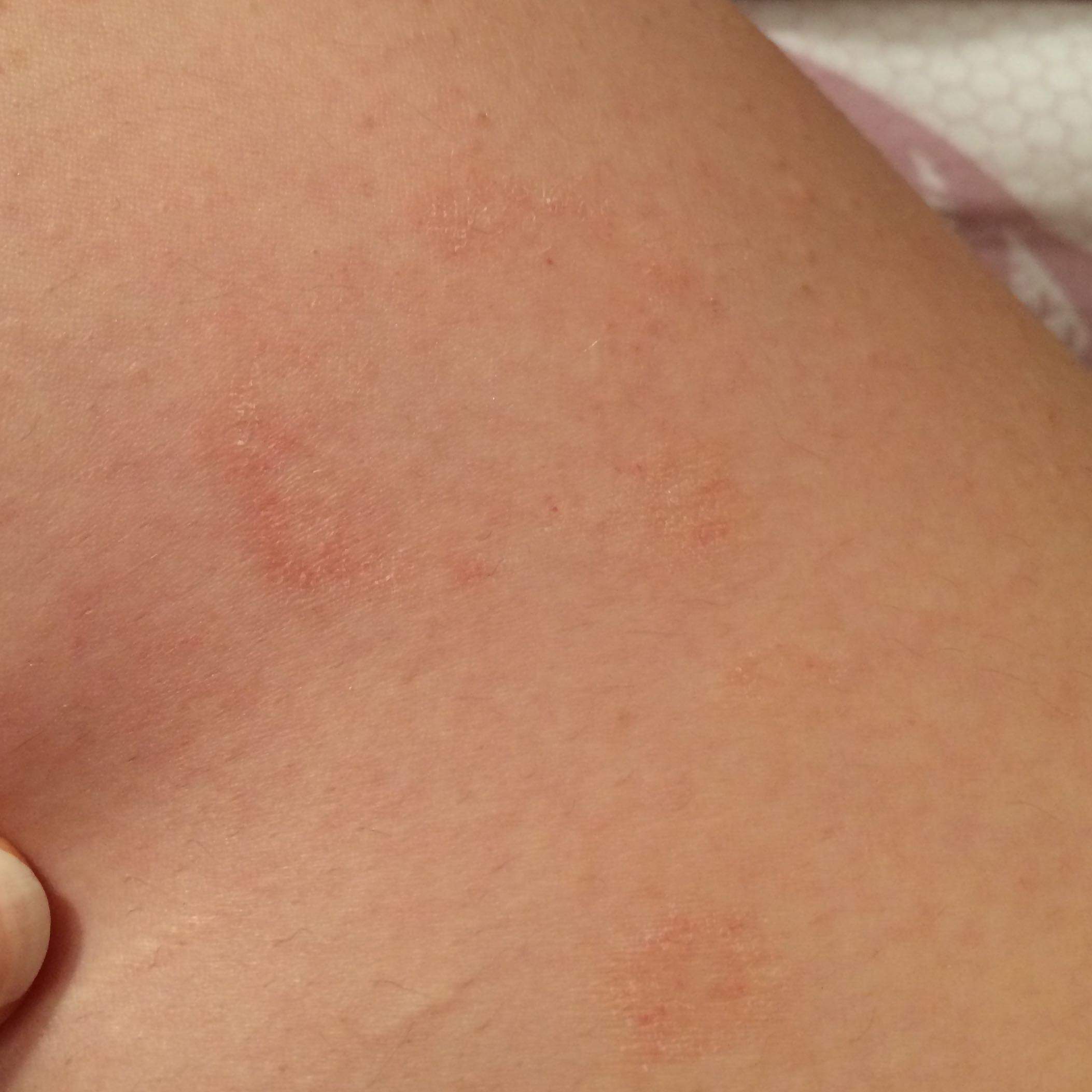 Rote Flecken auf der Haut seit längerem? (Gesundheit, Körper