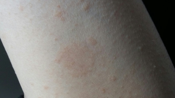 Achel - (Haut, Allergie, Flecken)