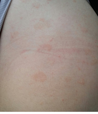 Rote Flecken Auf Der Haut Was Kann Kann Das Sein Allergie Rot Rote Flecken Auf Der Haut Was Kann Kann Das Sein Allergie Rot