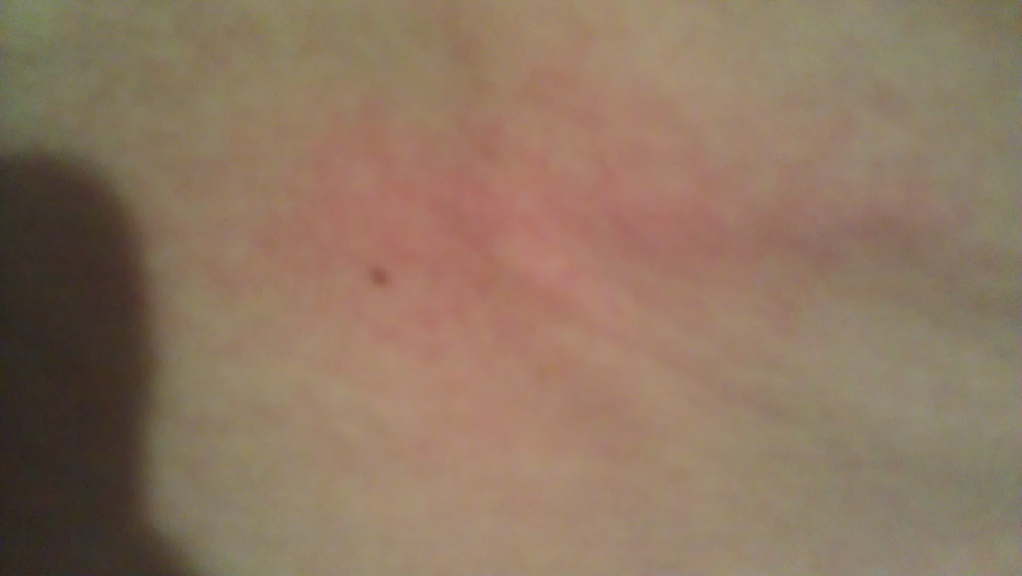Rote Flecken auf der Haut.Was sind das für Flecken? (Arzt, Allergie