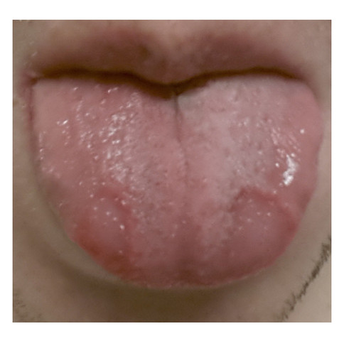 Zunge - (Arzt, Entzündung, Hals)