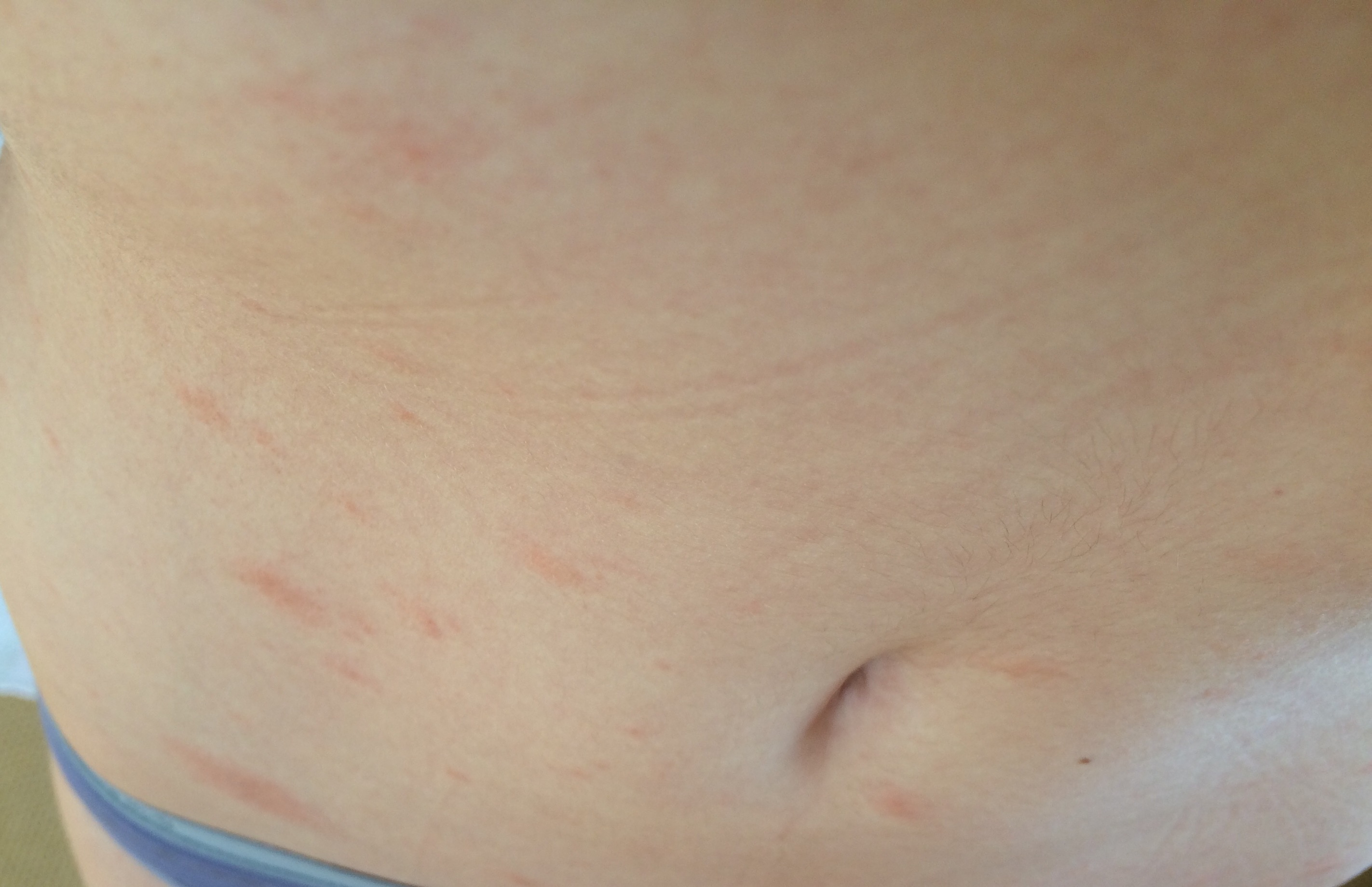 Rote Flecken größtenteils am Bauch. Was ist das? (Körper, Krankheit, rot) Rote Flecken größtenteils am Bauch. Was ist das? (Körper, Krankheit, rot)