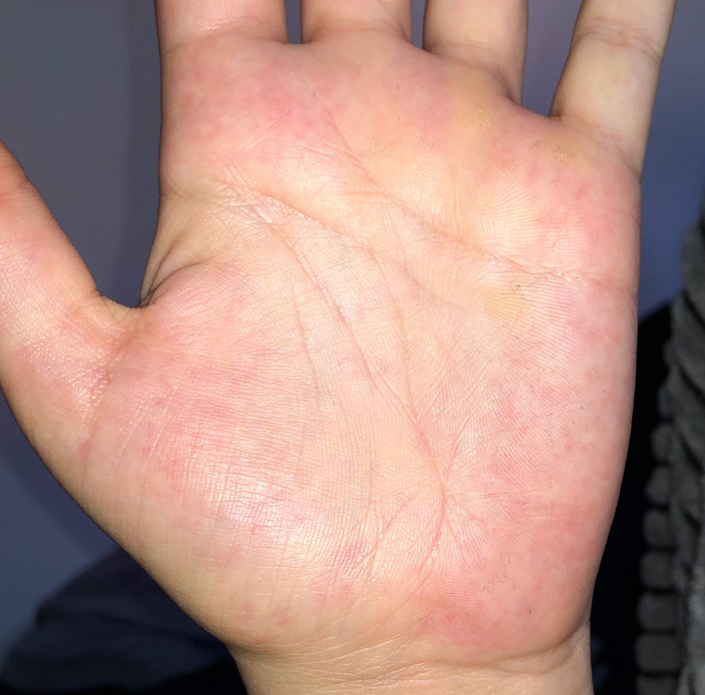 Rote „Flecken“ Handinnenfläche? (Schwangerschaft, Ausschlag) Rote „Flecken“ Handinnenfläche? (Schwangerschaft, Ausschlag)