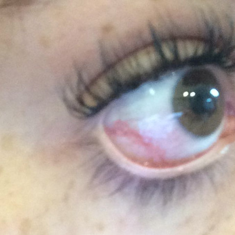 Rote Flecken Im Auge Nach Wimpernverlangerung Augen Wimpern