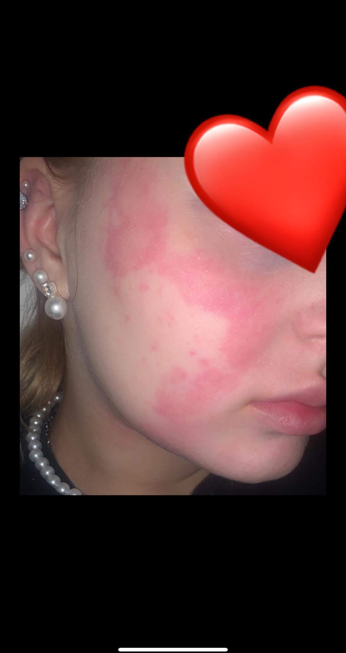 Rote Flecken im Gesicht? (Gesundheit und Medizin)