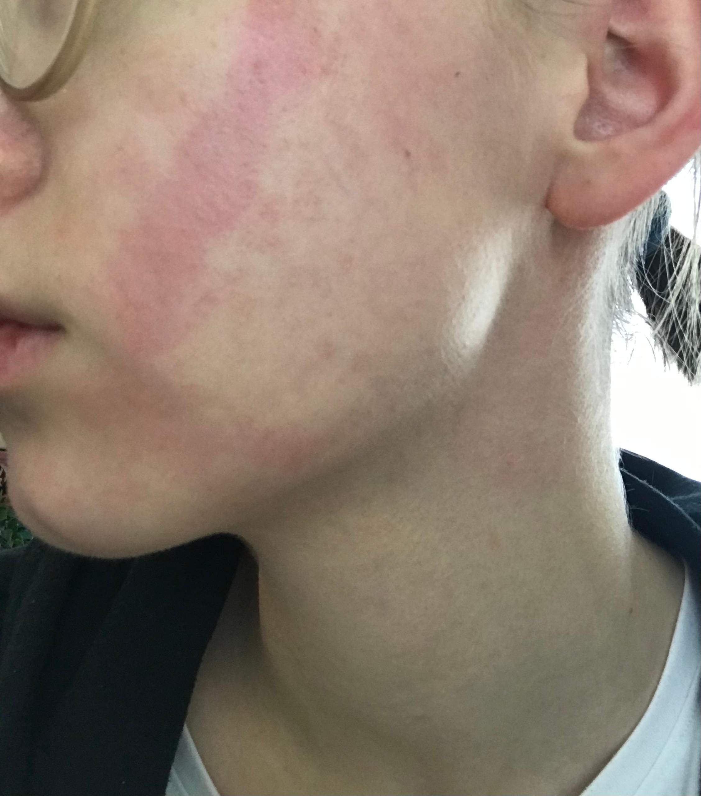 Rote Flecken im Gesicht? (Gesundheit und Medizin, Haut)