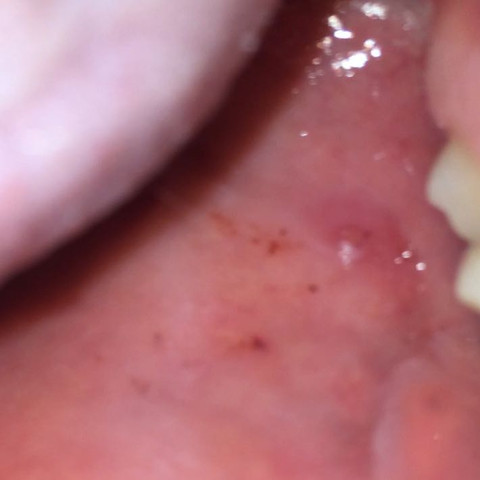 Rote Flecken Im Mund Gesundheit Hiv Rote Flecken Im Mund Gesundheit Hiv