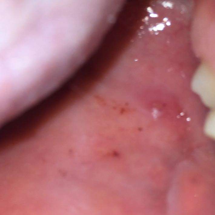 Rote Flecken Im Mund Gesundheit Hiv Rote Flecken Im Mund Gesundheit Hiv