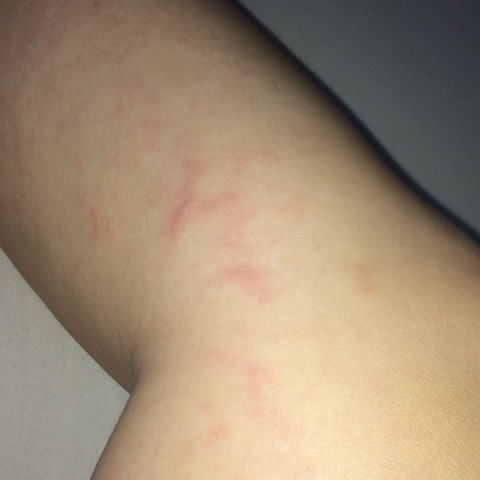 Rote Flecken Nach Duschen Am Bein Beine Rote Flecken Nach Duschen Am Bein Beine