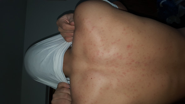 Rote Flecken Uber Den Ganzen Oberkorper Krankheit Haut Pubertat