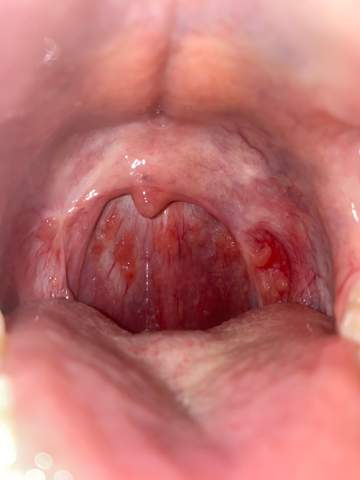 Rote Flecken Und Blasschen Im Hals Gesundheit Und Medizin Gesundheit Rote Flecken Und Blasschen Im Hals Gesundheit Und Medizin Gesundheit