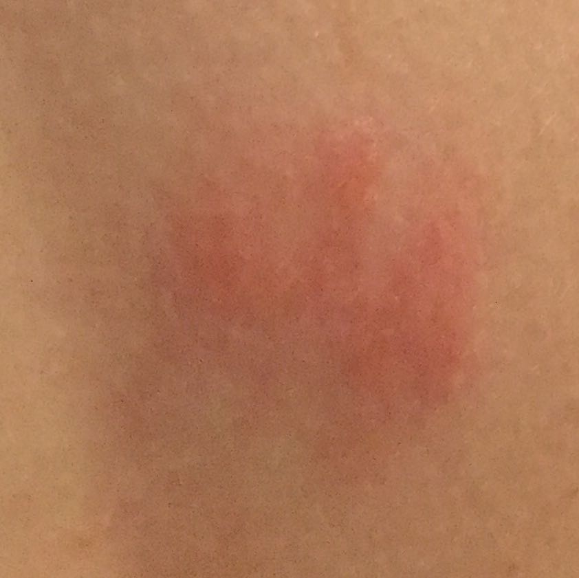 Rote Flecken/Pickel am Rücken pickel auf dem rücken