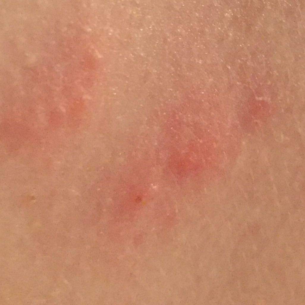 Rote Flecken/Pickel am Rücken?