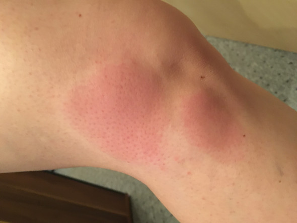 Rote Flecken Schwellungen Am Bein Rote Flecken Schwellungen Am Bein