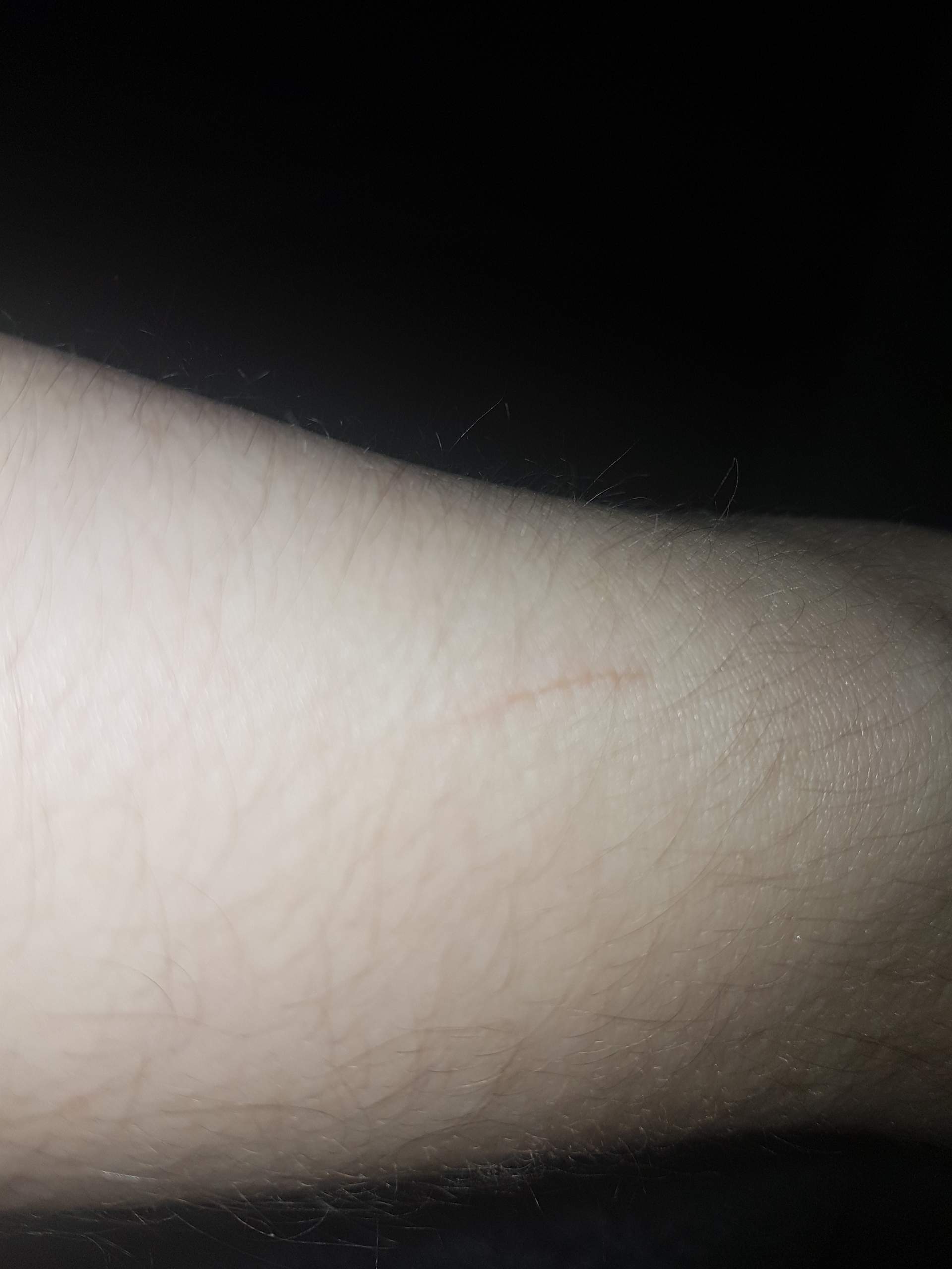 Rote gepunktete Streifen auf der Haut? (Gesundheit, Allergie, Ausschlag)