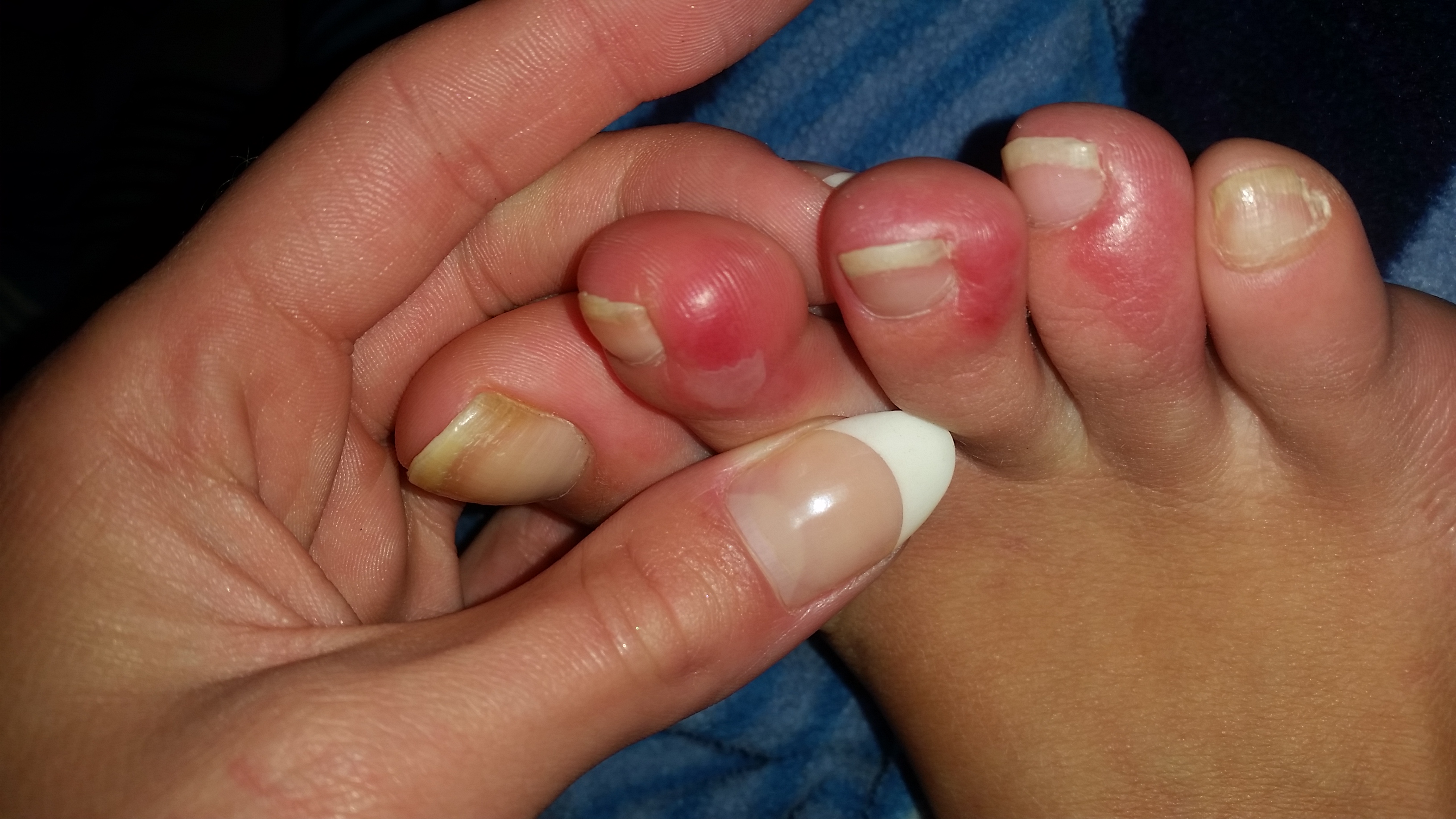 Rote geschwollene juckende brennende Schmerzempfindliche zehen? (Gesundheit, Medizin, Krankheit)