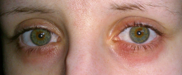 Rote Hautirritation unter dem Auge - HILFE (Gesundheit und Medizin