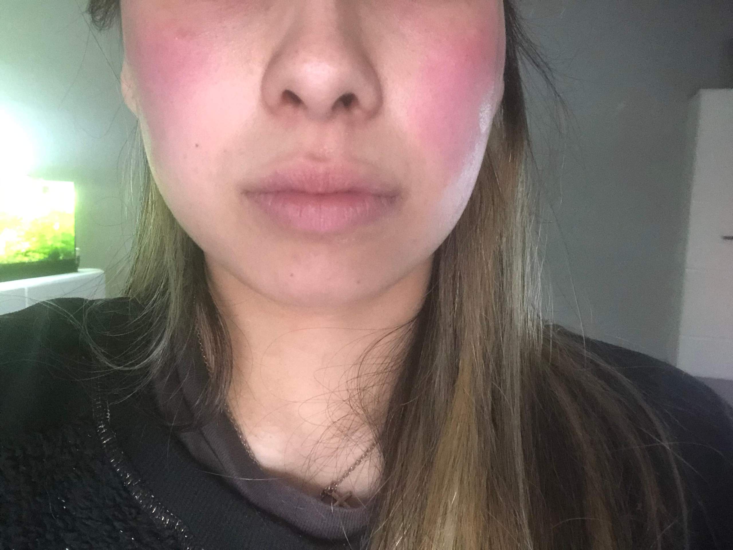 Allergische Reaktionen