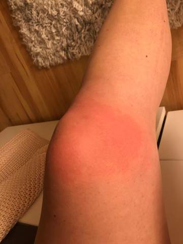 Rote Heisse Knie Und Fussgelenke Krankheit Gesundheit Und Medizin Knieschmerzen Rote Heisse Knie Und Fussgelenke Krankheit Gesundheit Und Medizin Knieschmerzen