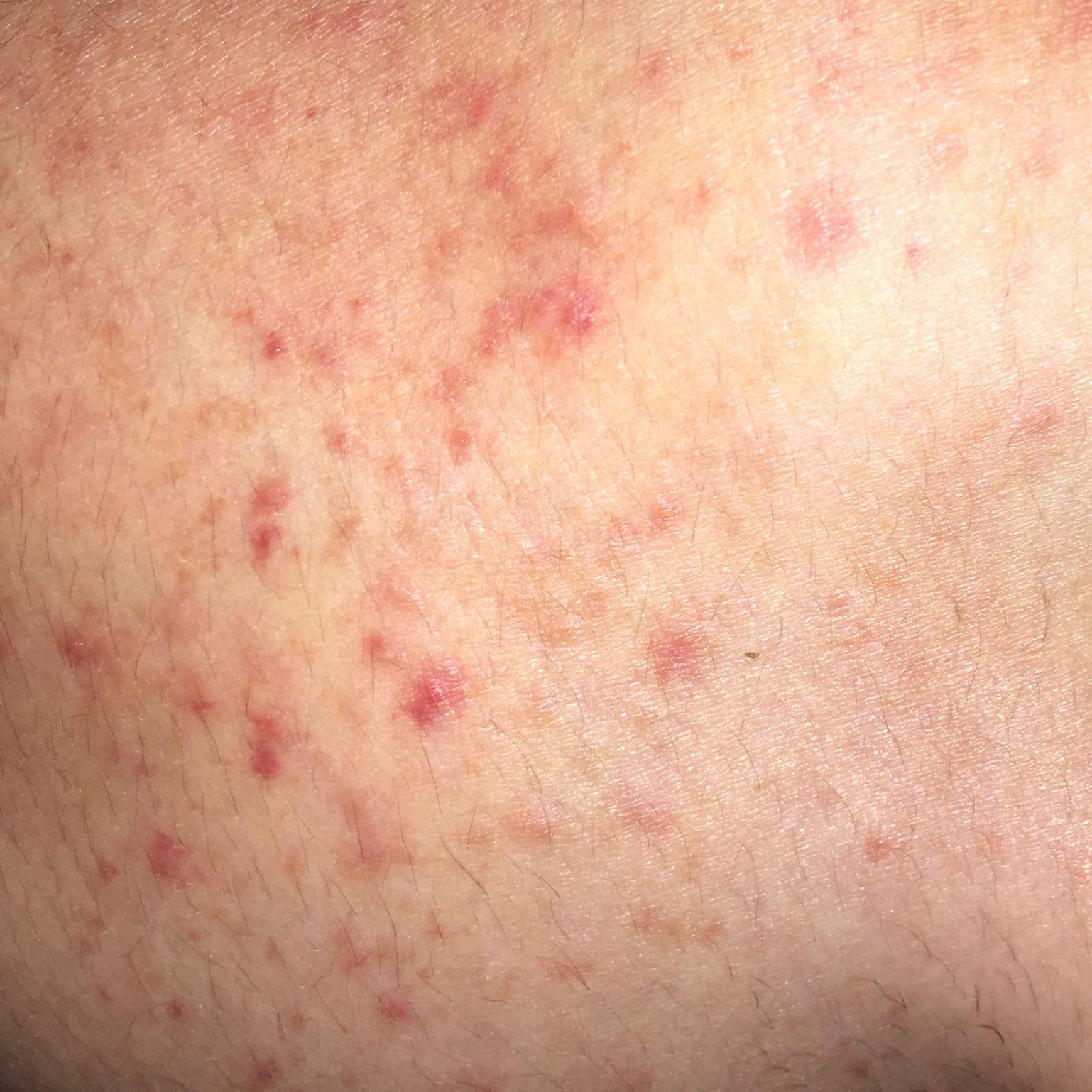 Rote juckende Pünktchen auf der Haut? (Gesundheit, rote-punkte, juckende Haut)