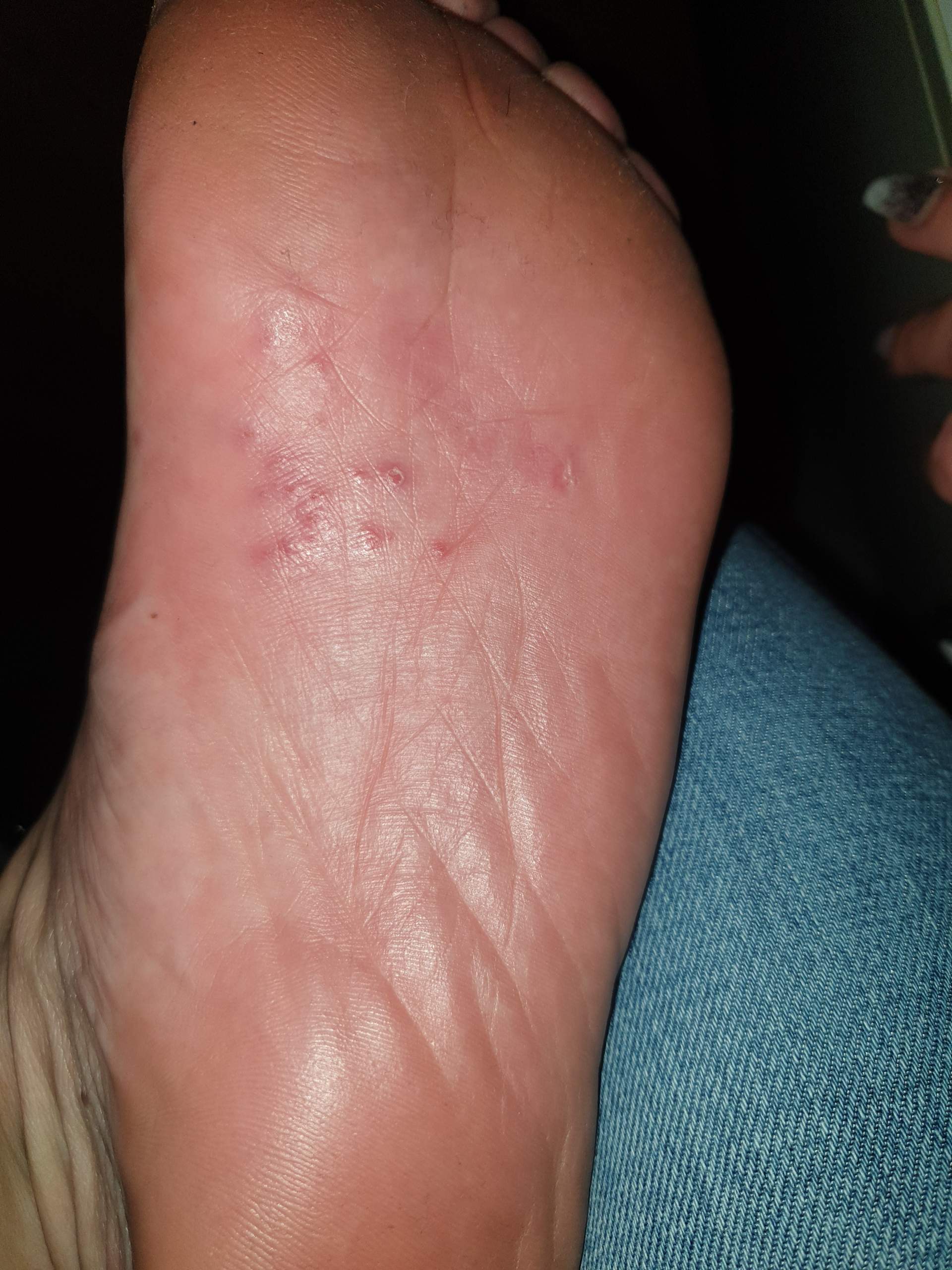 Rote juckende punkte an Fußsohlen was kann das sein? Und was hilft ...