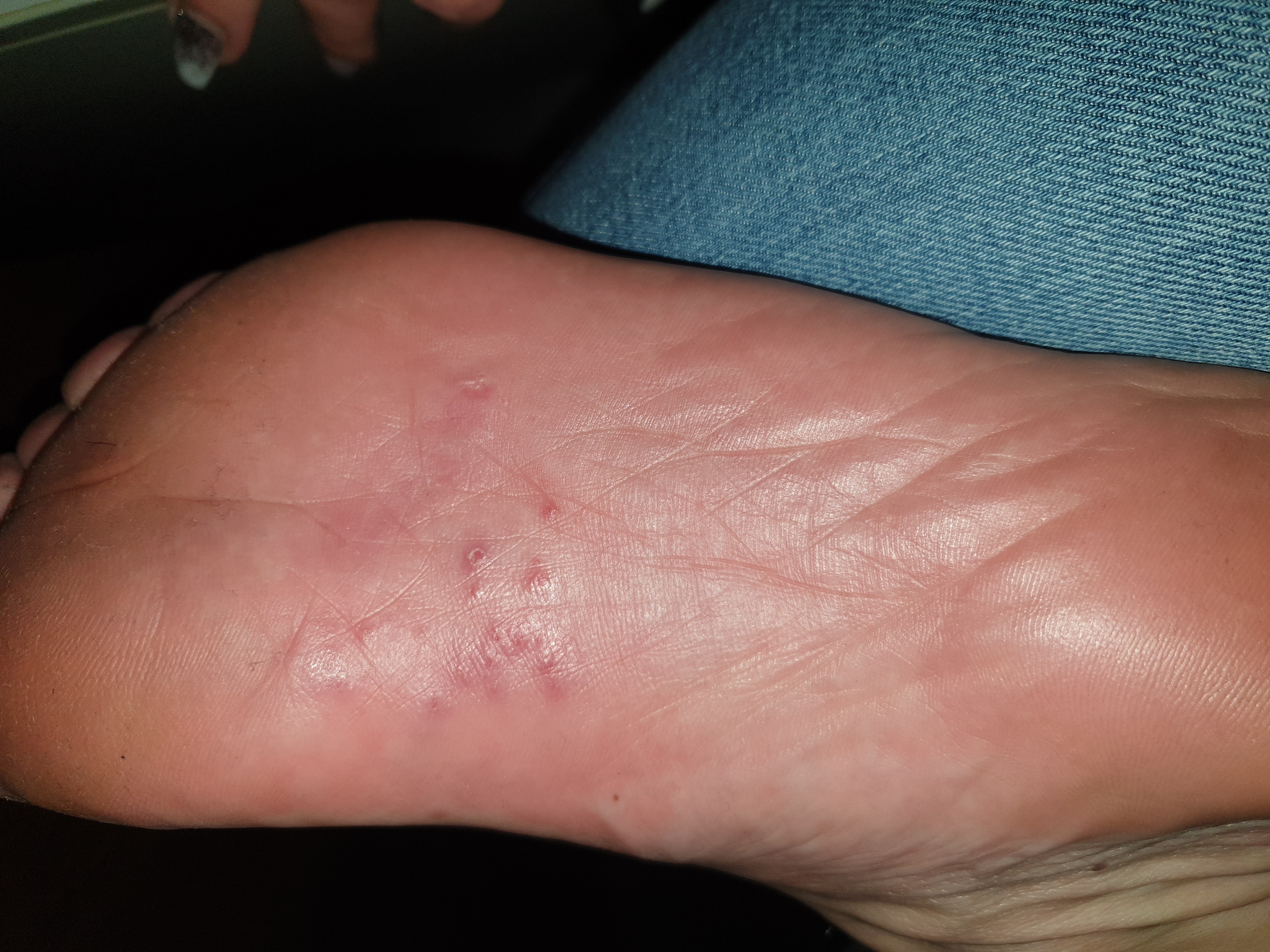 Rote juckende punkte an Fußsohlen was kann das sein? Und was hilft