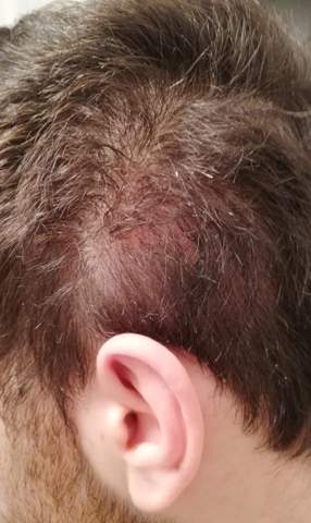 Rote Klebrige Stelle An Der Kopfhaut Gesundheit Und Medizin