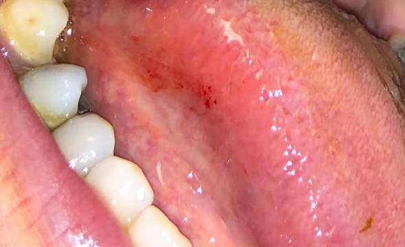 Rote kleine Flecken auf Zunge? (Gesundheit und Medizin)