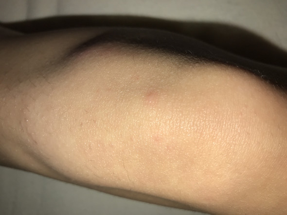 - (Körper, Haut, Pickel)