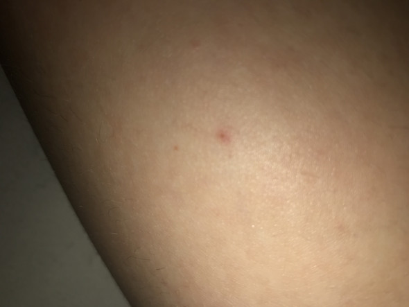 - (Körper, Haut, Pickel)