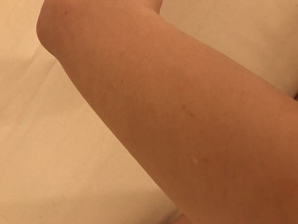 - (Körper, Haut, Pickel)