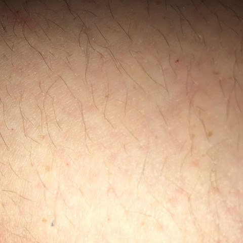 Rote Kleine Punktchen Am Ganzen Korper Blut Punkte Rot Rote Kleine Punktchen Am Ganzen Korper Blut Punkte Rot