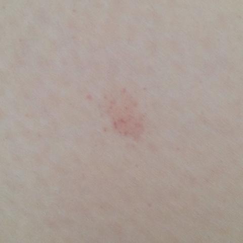 Rote kleine Punkte unter der Haut am Oberschenkel  - (Haut, Beine, Flecken)