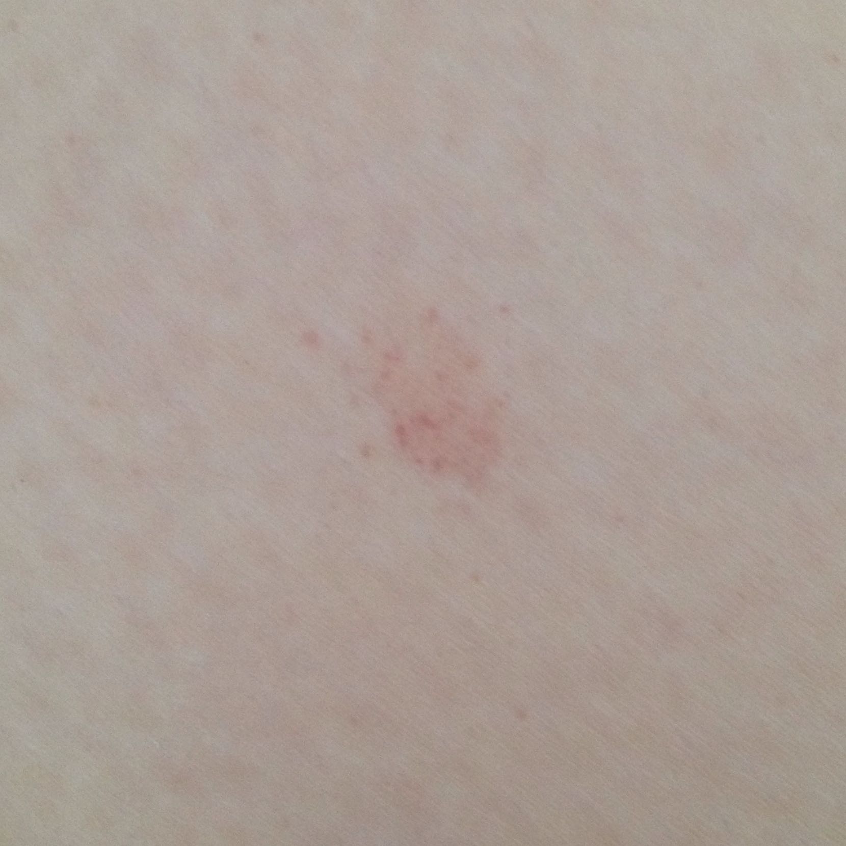Rote Blutflecken Unter Der Haut