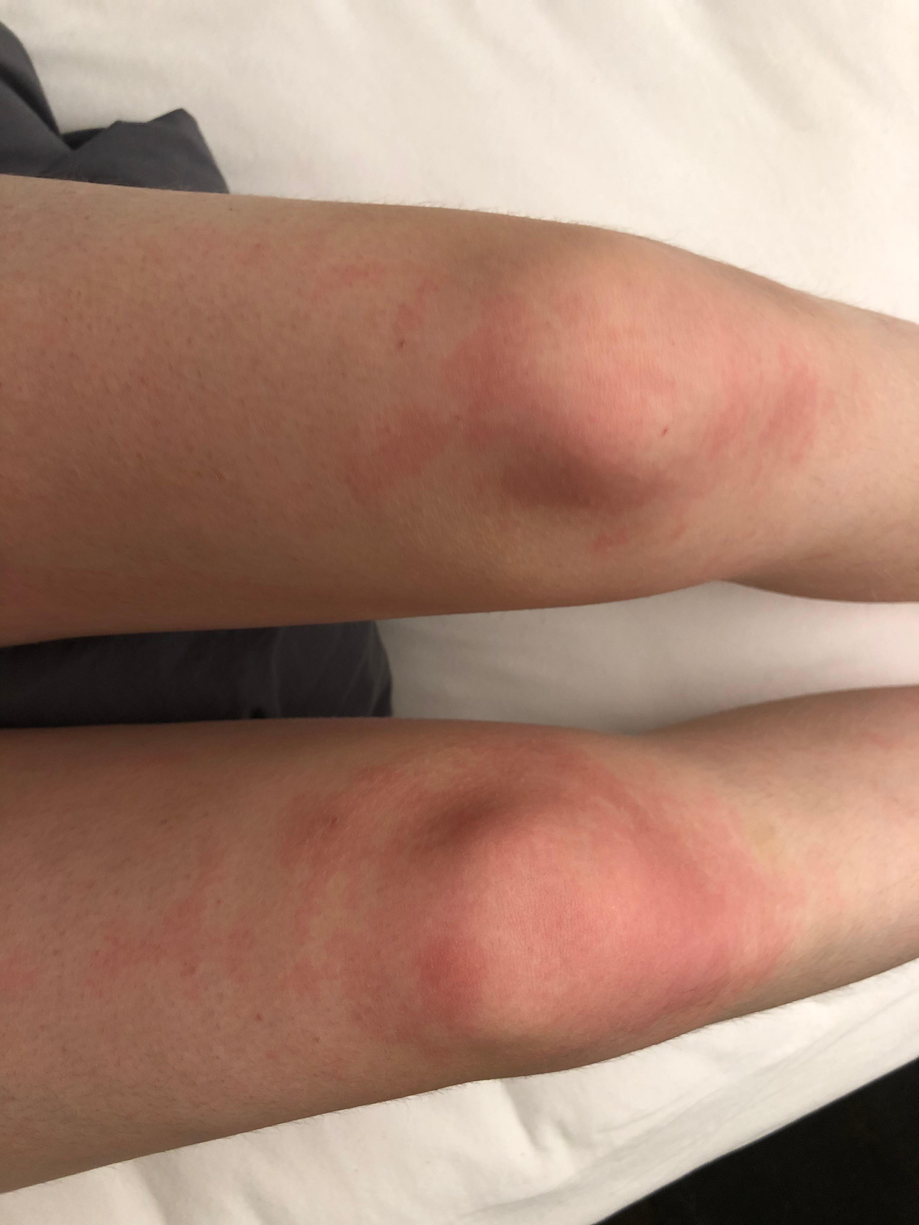 Rote Knie Nach Dusche Gesundheit Und Medizin Knieschmerzen Rote Knie Nach Dusche Gesundheit Und Medizin Knieschmerzen