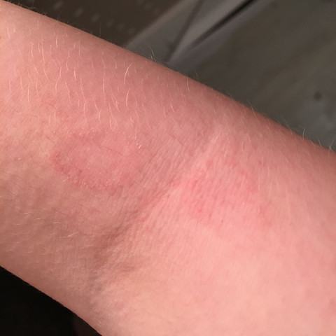 Hier seht ihr die roten Kreise auf meinem Arm.  - (Gesundheit und Medizin, Arm, Ausschlag)