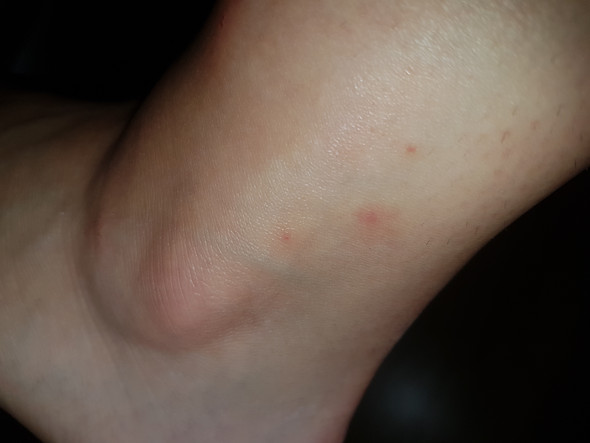 pickel jucken pickel jucken