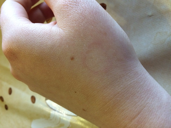 Roter Fleck an der Hand - (Krankheit, Haut, krank)