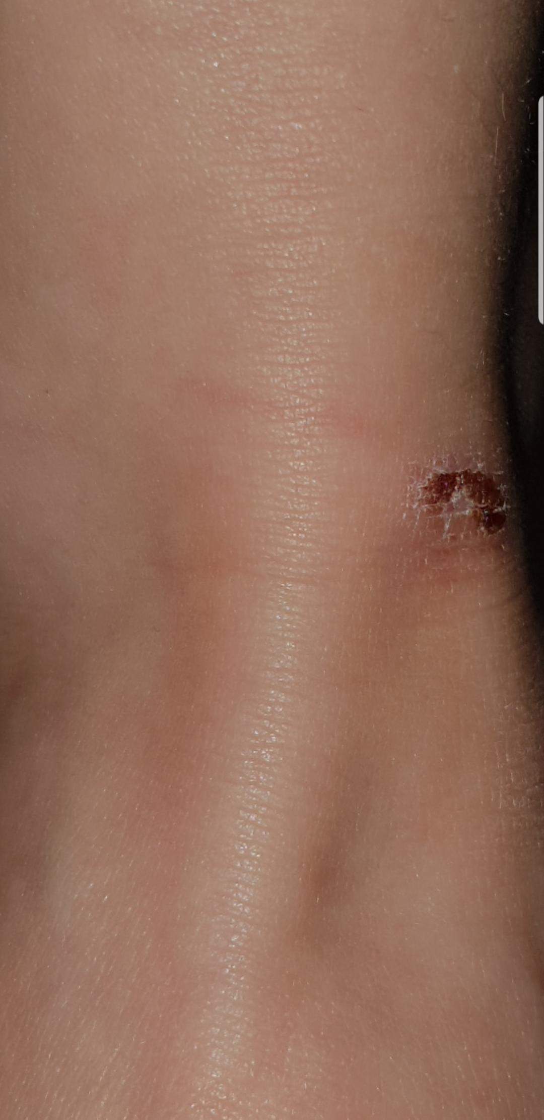 Wie Sieht Der Rote Strich Bei Einer Blutvergiftung Aus Rote Linie - Blutvergiftung? (Computer, Blutvergiftungsgefahr)